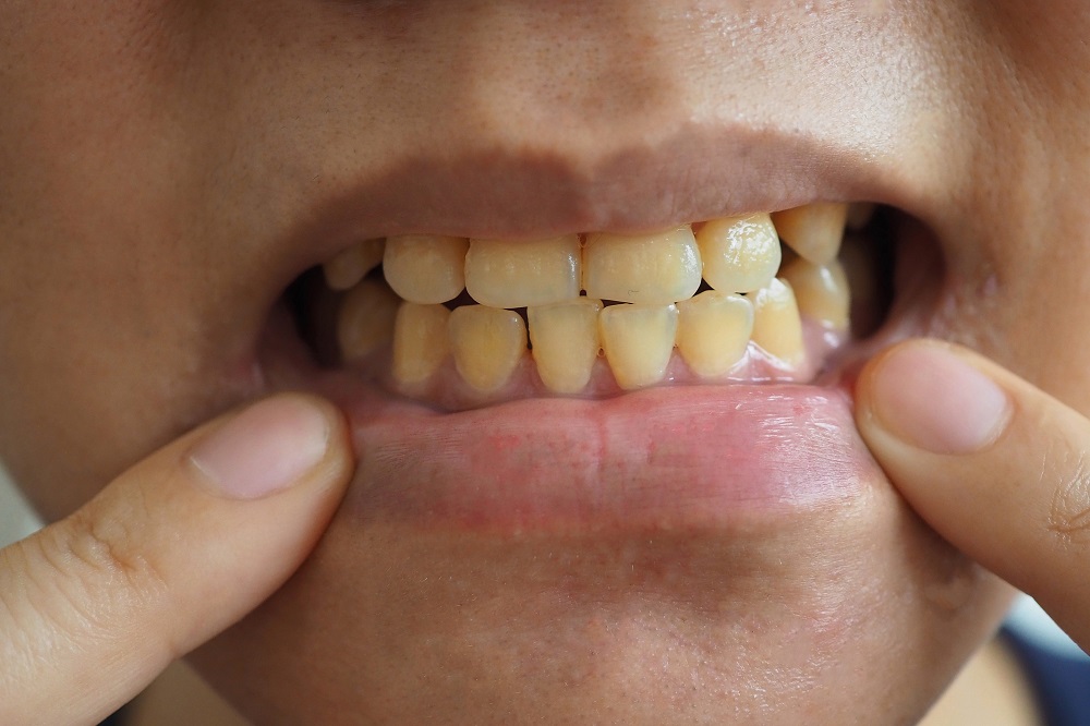 Przebarwienia na zębach - jak sobie z nimi poradzić?