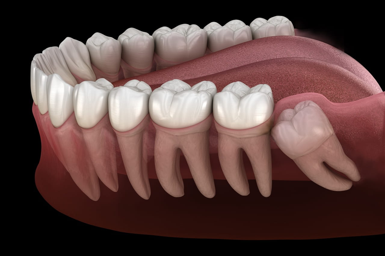 Ząb mądrości - czy zawsze trzeba go usuwać?